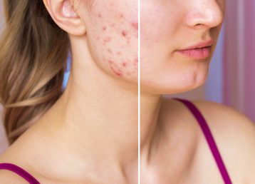 Korean Acne Treatments